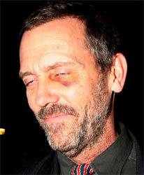 Hugh-Laurie-olho-roxo